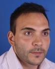 After Hair Transplant&nbsp;Front